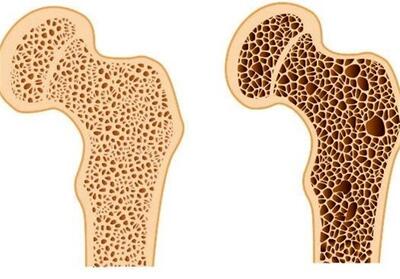 این علائم نشانه پوکی استخوان است