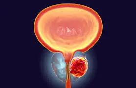 هشدار |سرطان پروستات در مردان بسیار جدی است