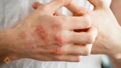 توصیه‌هایی برای افراد مبتلا به اگزمای پوستی + فیلم