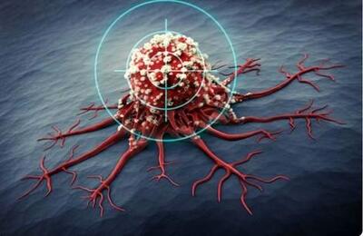 رییس مرکز تحقیقات سرطان ایران: سن سرطان‌ در ایران ۱۰ سال پائین تر از دیگر کشورهای جهان است