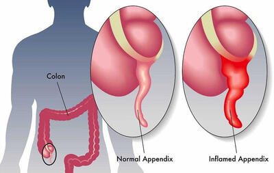این علامت یعنی درد آپاندیس دارید
