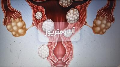 شیراز مرجع تشخیص و درمان اندومتریوز در کشور