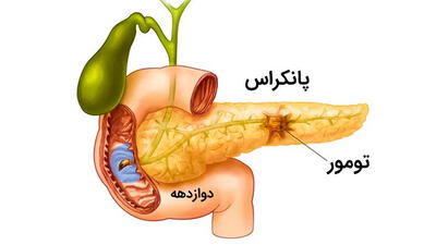 سرطان پانکراس چیست؟