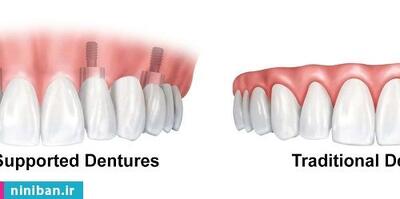 قیمت دندان مصنوعی با پایه ایمپلنت