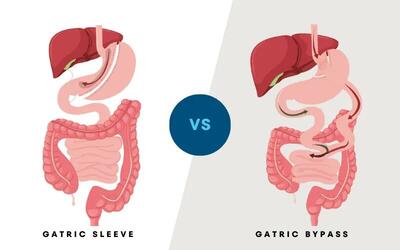 اسلیو معده یا بایپس معده؟ انتخاب مناسب با دکتر سعید شمس، جراح چاقی