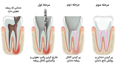 ویدئو مراحل درمان ریشه و روکش دندان در کلینیک دندانپزشکی روانمهر