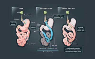 معرفی انواع جراحی بای پس معده + بررسی مزایا و معایب هر روش