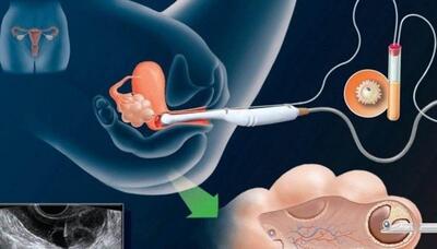 ۷ تا از مهمترین دلایل ناموفق بودن IVF (آی وی اف)