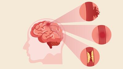 ابداع روشی برای رشد مجدد رگ‌های خونی مغز پس از سکته