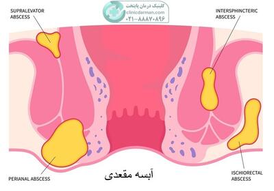 آبسه مقعدی و بهترین راه درمان، نکات و راهکارهای طلایی ✨