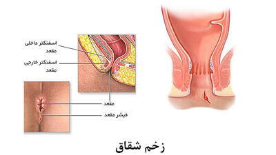 شقاق مقعدی چیست؟ + جدول داروهای گیاهی و شیمیایی برای درمان شقایق مقعدی