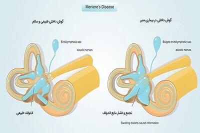 بیماری منیر چیست؟/هر چیزی که باید درمورد بیماری منیر بدانید اندیشه معاصر