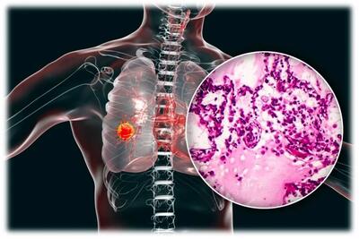 کشف یک روش ساده برای تشخیص زودهنگام سرطان ریه