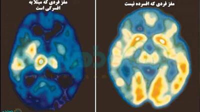 میگنا - مغز فرد افسرده، یک میدان جنگ واقعی است!