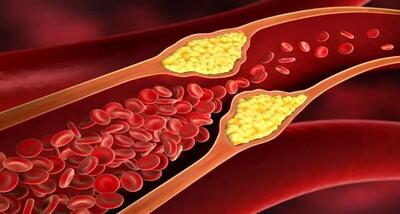 رایج ترین علائم چربی خون بالا + روش های درمان