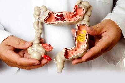 علائم اولیه سرطان روده که باید جدی بگیرید