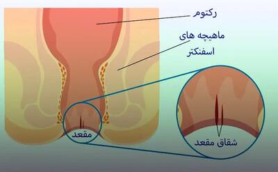 جوش خوردن زخم شقاق