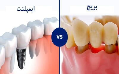 پل دندان بهتر است یا ایمپلنت؟