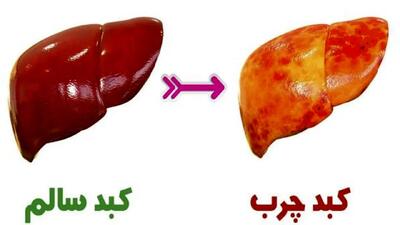 نشانه‌های اولیه کبد چرب که باید بدانید