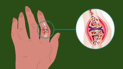 آرتریت چیست؟ /