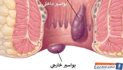 درمان بیماری بواسیر؛ از دغدغه های ورزشکاران و وزنه برداران - پارس فوتبال