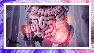 روند جهانی رو به رشد سرطان روده بزرگ در میان جوانان