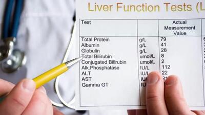 total bilirubin بالا نشانه چیست؟ + فیلم