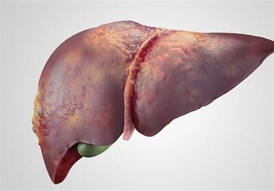 درمان قطعی کبد چرب/ دلایل ابتلا چیست؟ - تسنیم