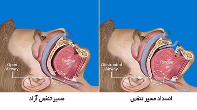 میگنا - آپنه خواب باعث افزایش سرعت پیری می‌شود