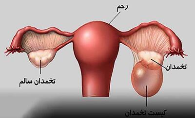 راه درمان کیست تخمدان بدون دارو | از بین بردن کیست تخمدان با پوست پیاز