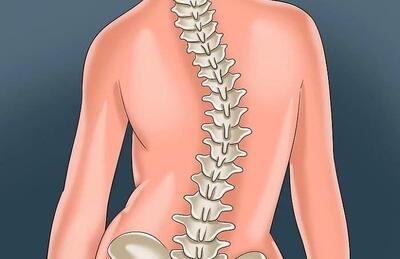 سه درصد مردم به انحراف ستون فقرات مبتلا هستند؛ تشخیص و درمان اسکولیوز
