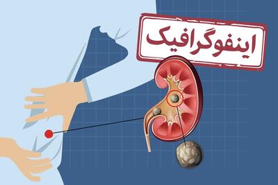 اینفوگرافیک/ چطور از ایجاد سنگ کلیه پیشگیری کنیم؟