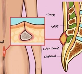 درمان قطعی کیست مویی کمر  - سبک ایده آل