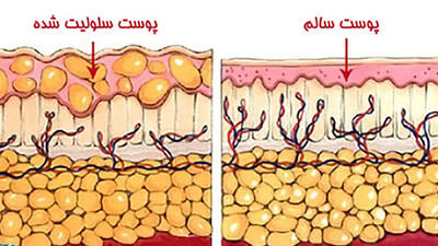 سلولیت چیست؟ / راهکارهای پیشگیری از سلولیت + جداول مربوط