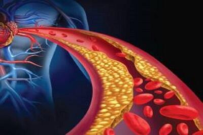 خطرات بالا بودن چربی خون که از آن بی‌خبرید