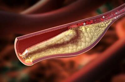 چرا باید از بالا بودن کلسترول خود بترسید؟