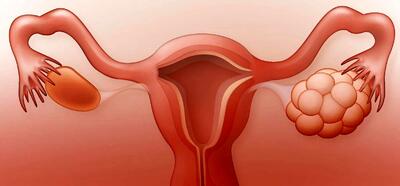 آیا تخمدان پلی کیستیک باعث ناباروری میشود؟