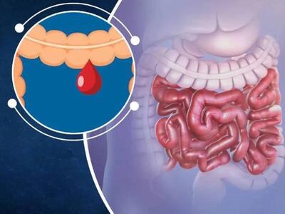 فیلم/ روشی جدید در کنترل خونریزی‌های گوارشی