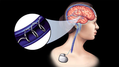 درمان بیماری‌های عصبی با فناوری نوین شرکت NeuroBionics