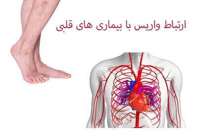 آیا واریس می‌تواند باعث سکته قلبی شود؟