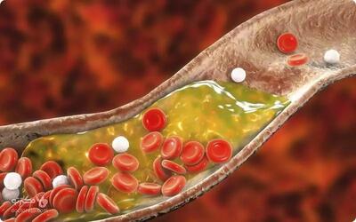 درمان چربی خون مضر با مصرف روزانه این مواد طبیعی