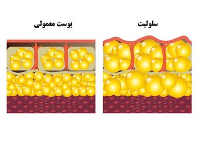 آیا سلولیت در خانه قابل درمان است؟ بهترین روش درمان سلولیت در منزل