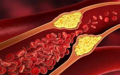 هشدار! این علائم نشان می‌دهند که کلسترول شما خطرناک افزایش یافته است؛ حتماً بخوانید! اندیشه معاصر