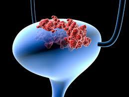 علائم سرطان مثانه در مردان چیست و چه درمانی دارد؟ - سبک ایده آل