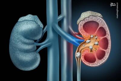 اینفوگرافیک/ ۸ عادت غلط که سبب بروز سنگ کلیه می‌شود