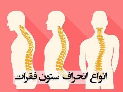 نقش کمربند، تغذیه و ورزش در درمان انحراف ستون فقرات