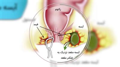 ابسه مقعدی چیست؟ + فیلم