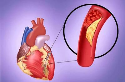 اهدای خون، چگونه جلوی سکته قلبی را می‌گیرد؟