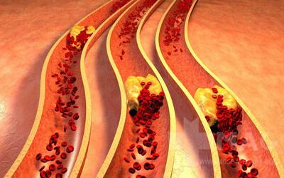 چربی خون بالا: همه چیز درباره علل، علائم و درمان‌های مؤثر