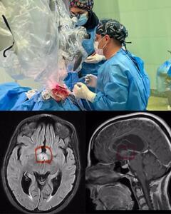 عمل جراحی تومور داخل بطن مغز در ایلام با موفقیت انجام شد